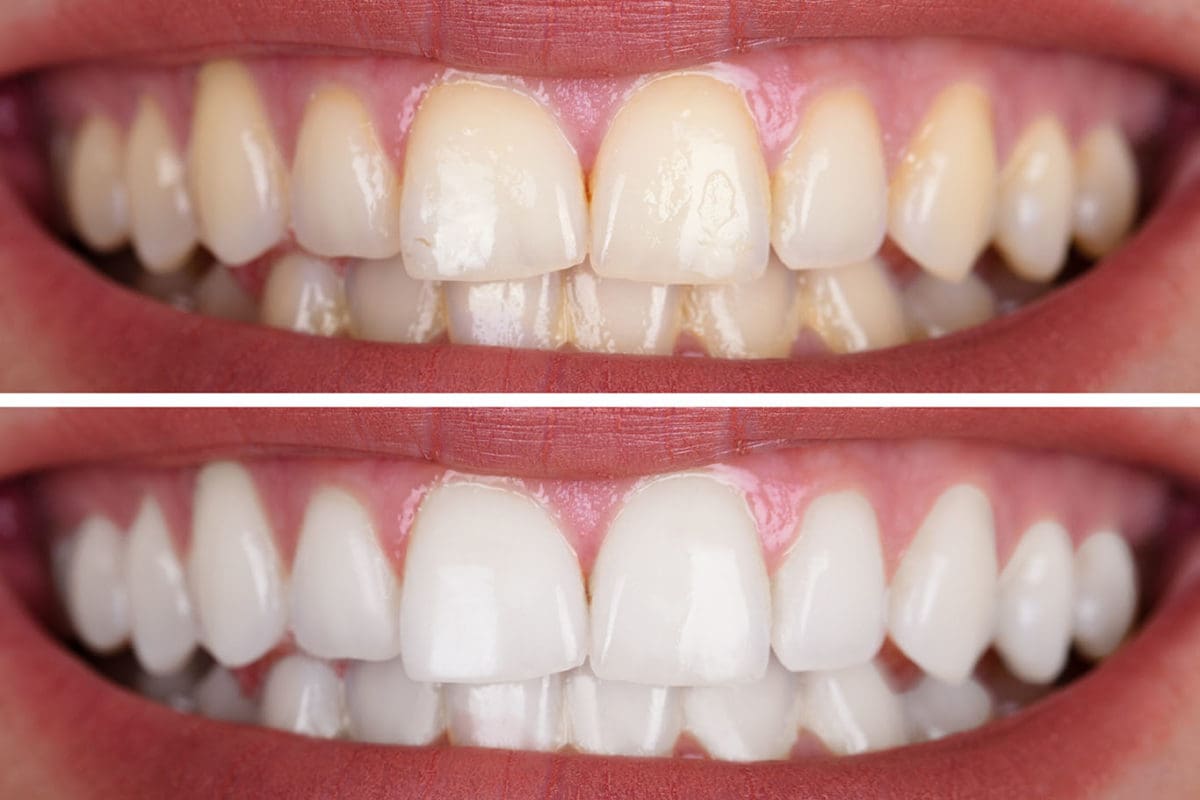 Teeth Whitening In Auckland | Zoom Smiles In Days