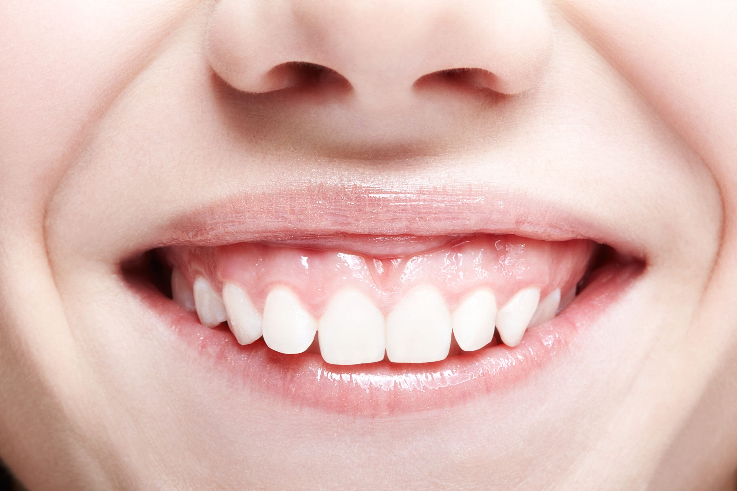 A close-up of a woman's mouth showcasing white teeth after a gum lift.
