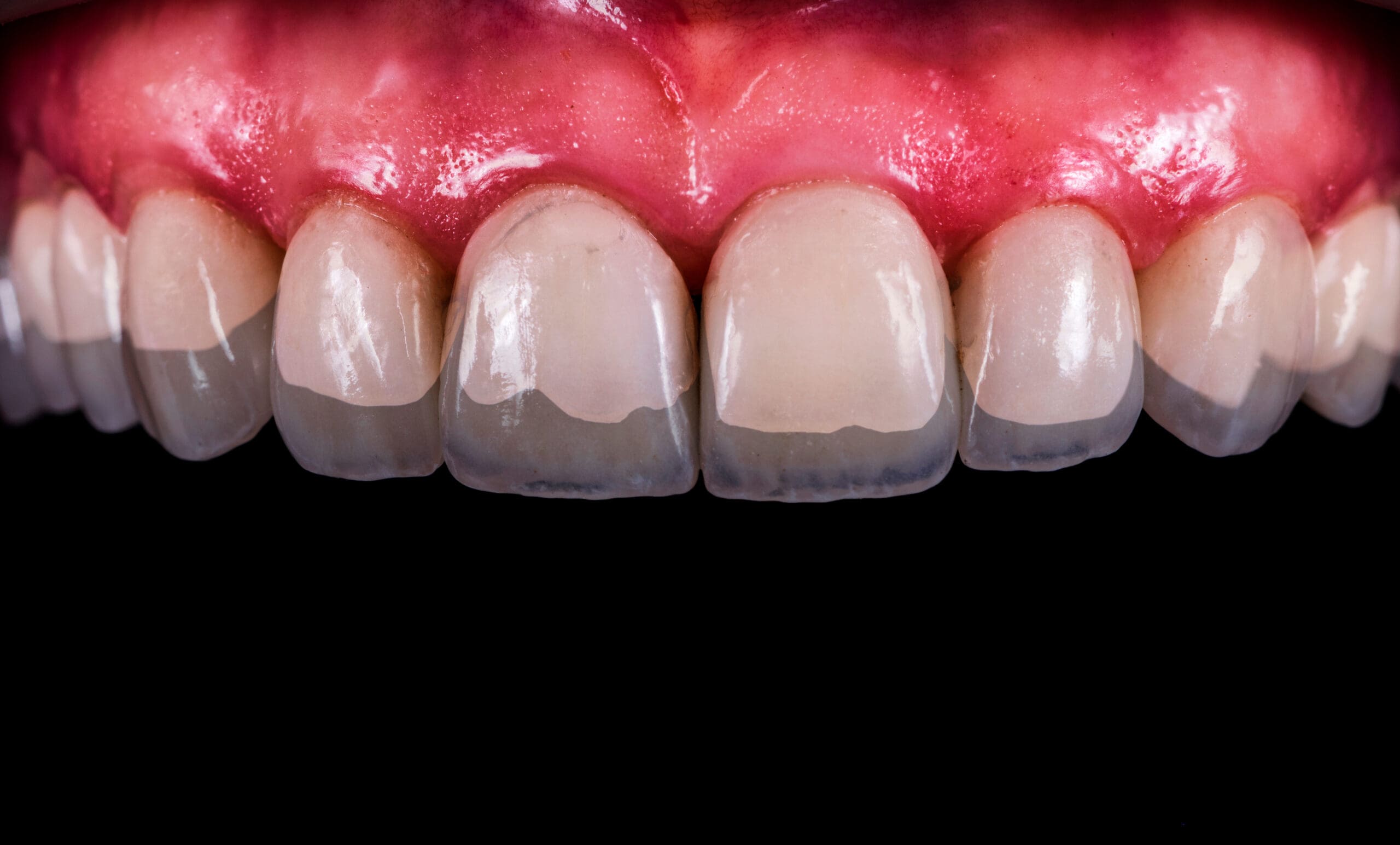 A close up of a tooth with an Invisalign filling.