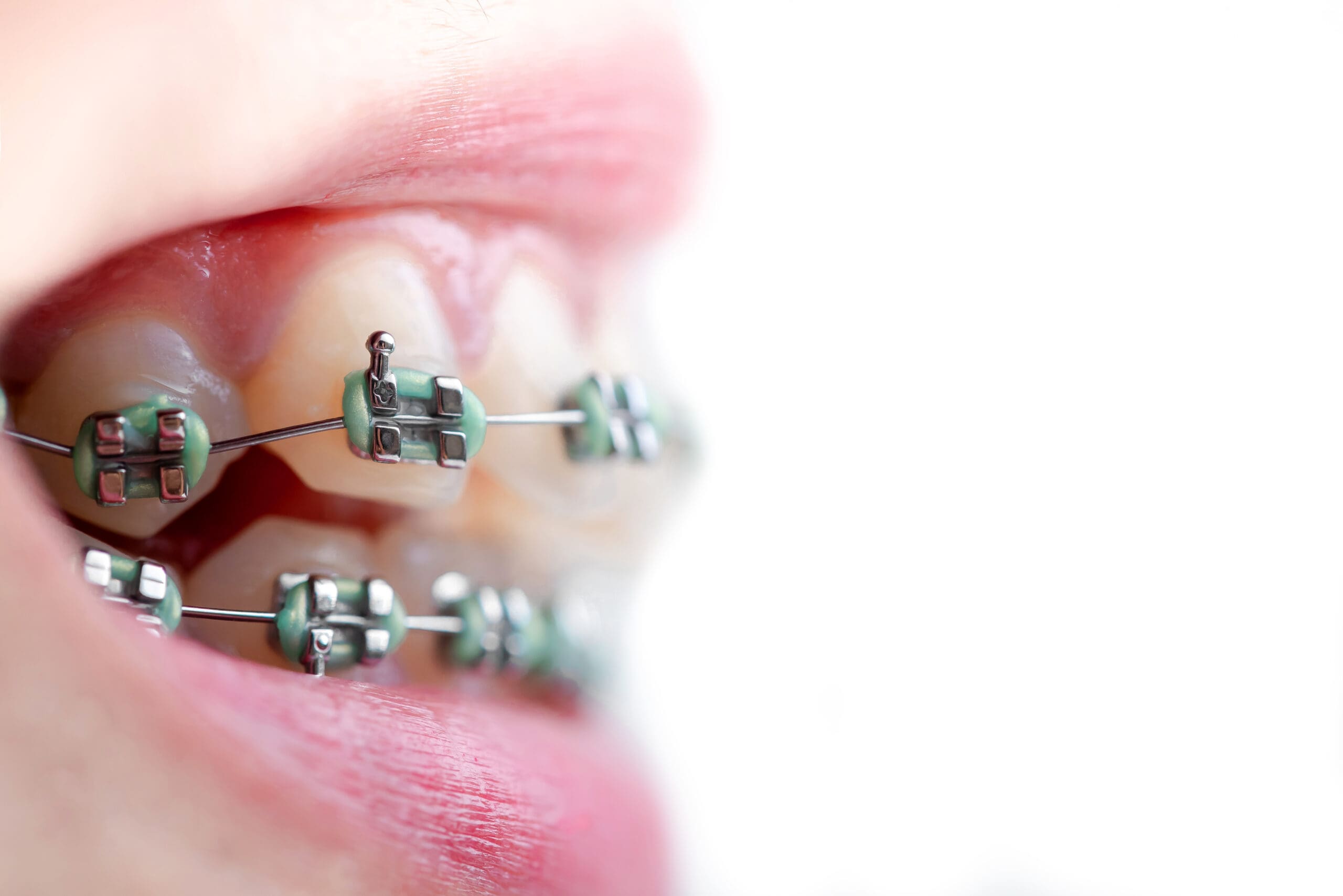 A close up of a person's mouth undergoing the orthodontic process with braces.