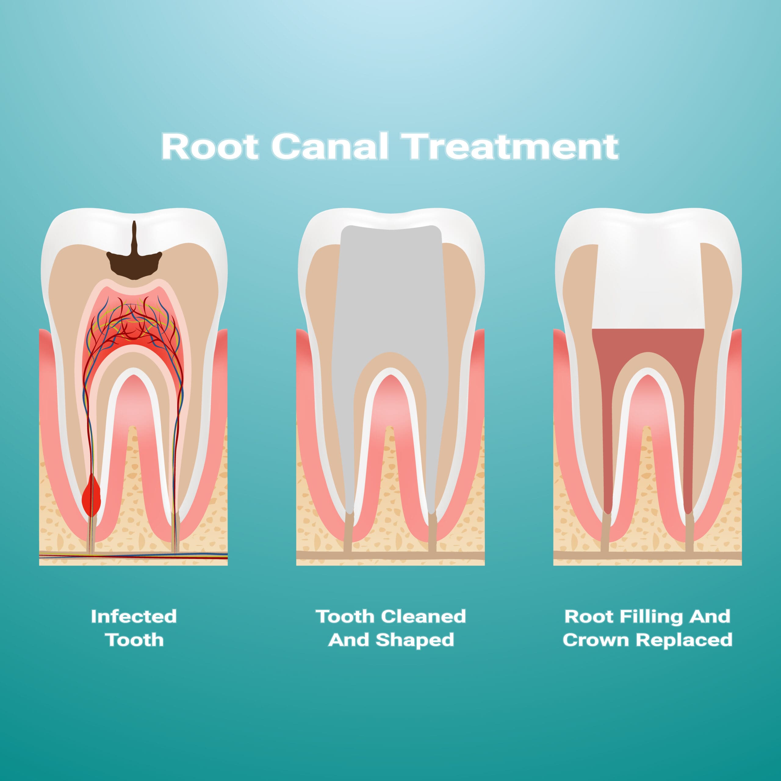 The stages of root canal treatment for tooth extraction in Auckland.