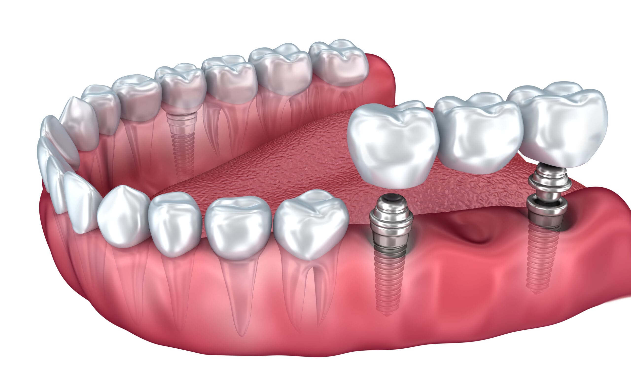 An image of a dental implant.
