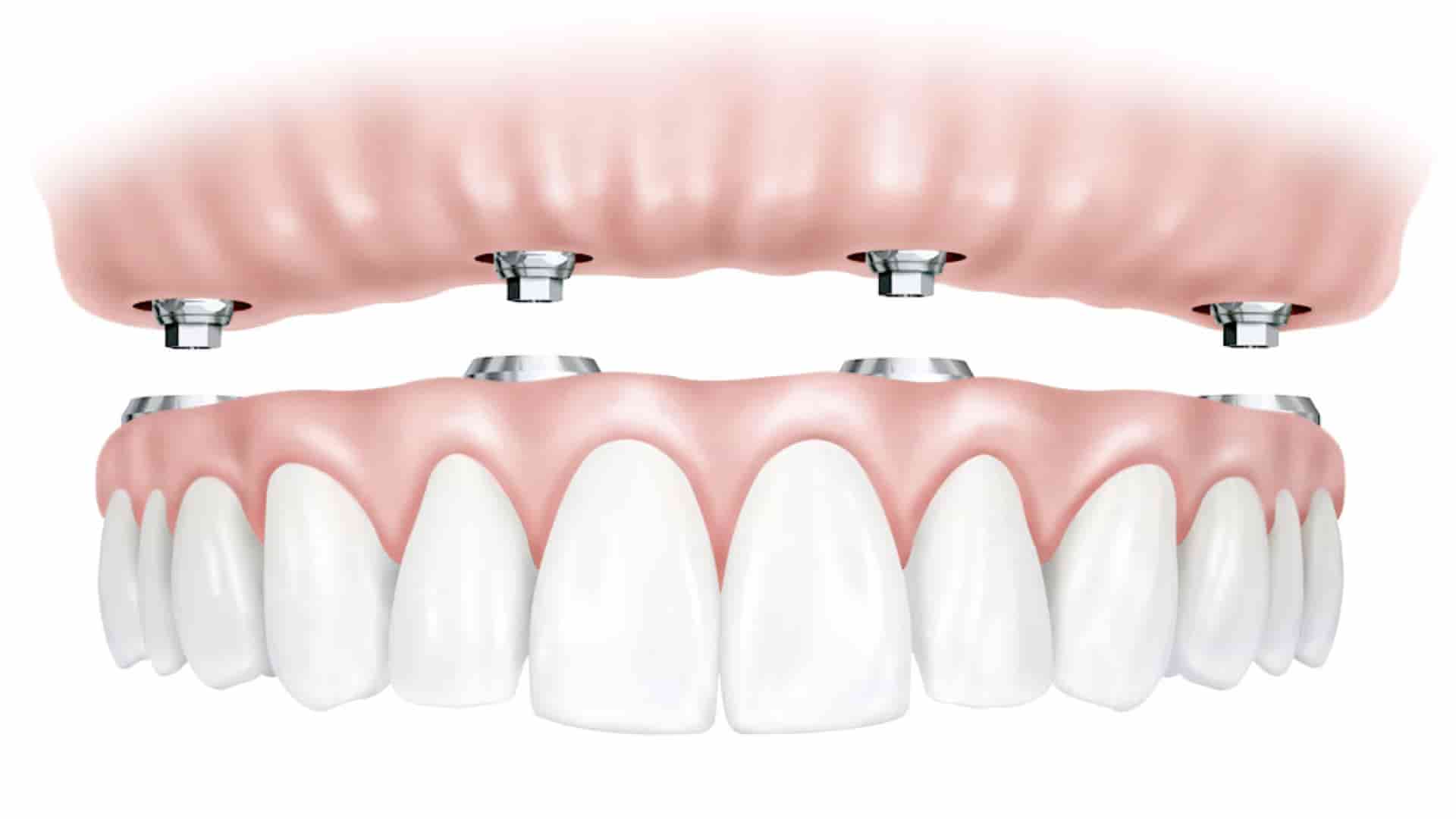 An illustration of a dental implant in Auckland.